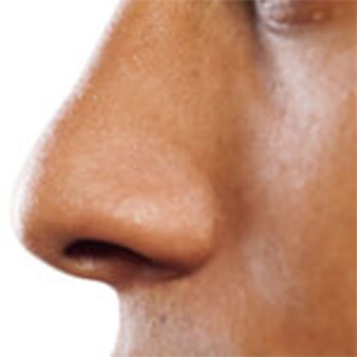 NOSE IMPERFECTION