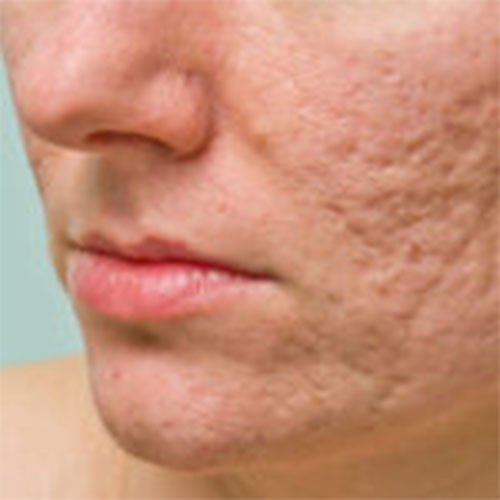 SCARRING & ACNE SCARRING