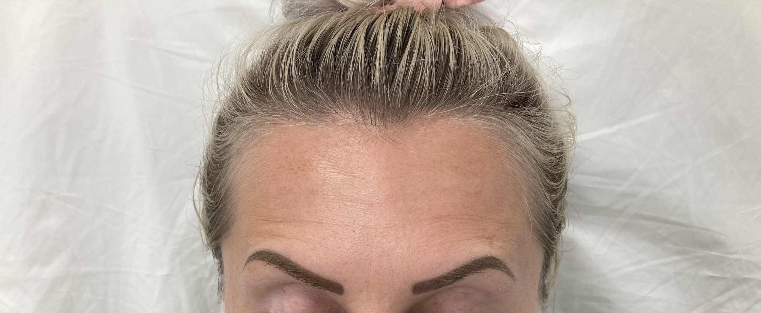 After-Anti-Wrinkle Injections