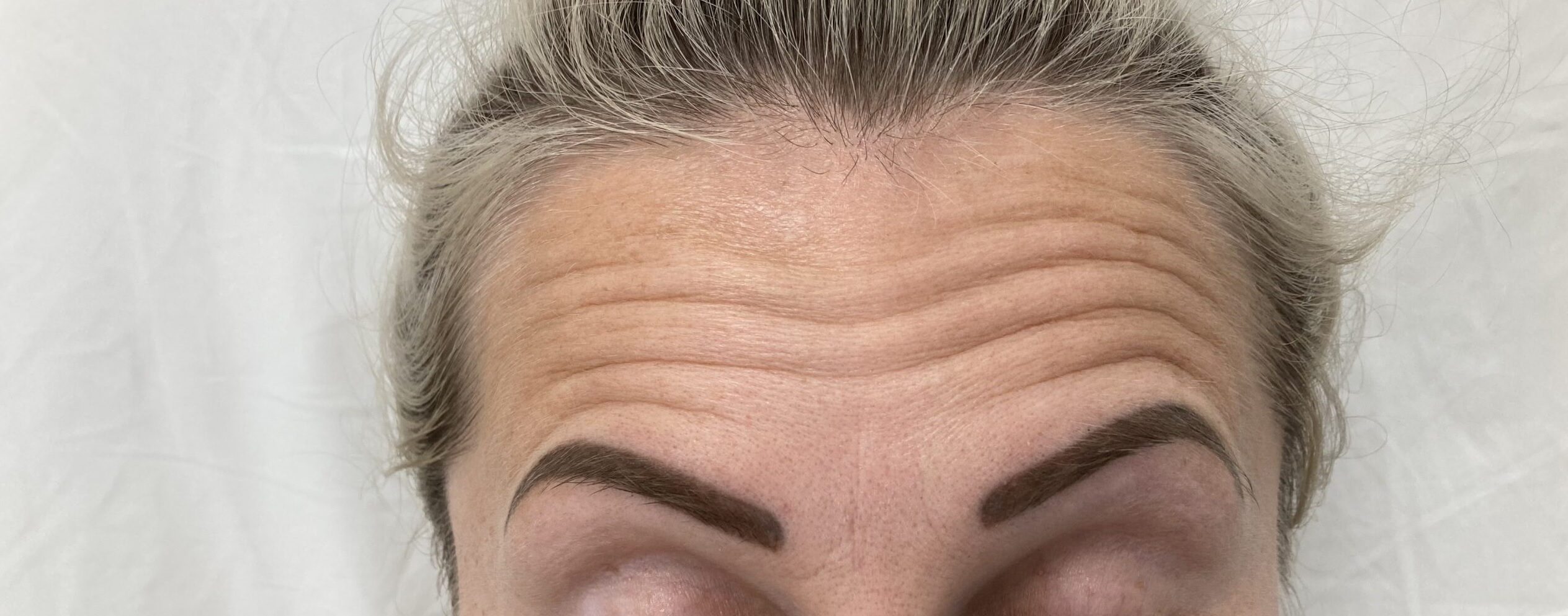 Before-Anti-Wrinkle Injections