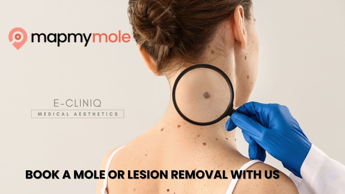 Map my mole
